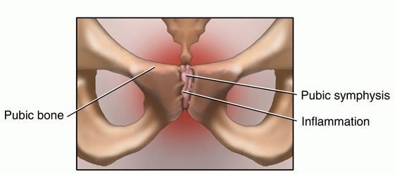 Osteitis Pubis » Motion Health Centre