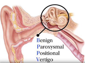 BPPV - Benign Paroxysmal Positional Vertigo