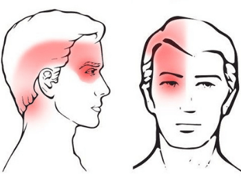 Cervicogenic Headaches