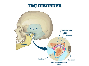 Jaw Pain - TMJ Dysfunction