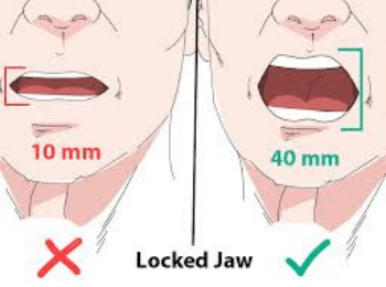 Lockjaw