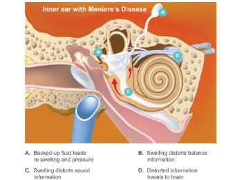Ménière's Disease