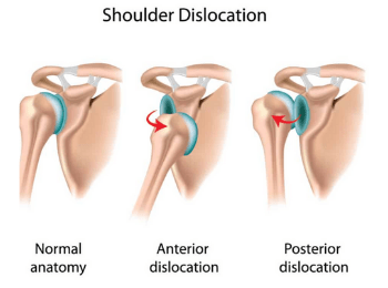 Shoulder Dislocation