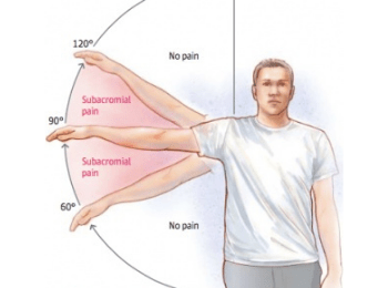 Shoulder Impingement (2)