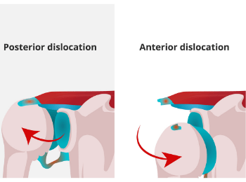 Shoulder dislocation