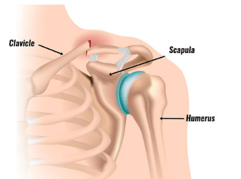Clavicular Fracture