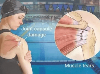 Swimmer's Shoulder