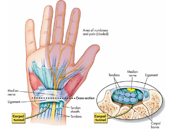Carpal Tunnel Syndrome