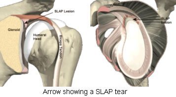 Shoulder Labrum SLAP Tear