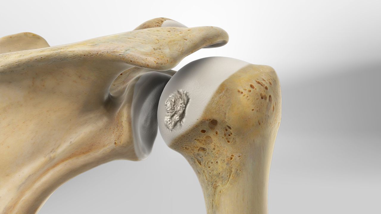 hill sachs lesion