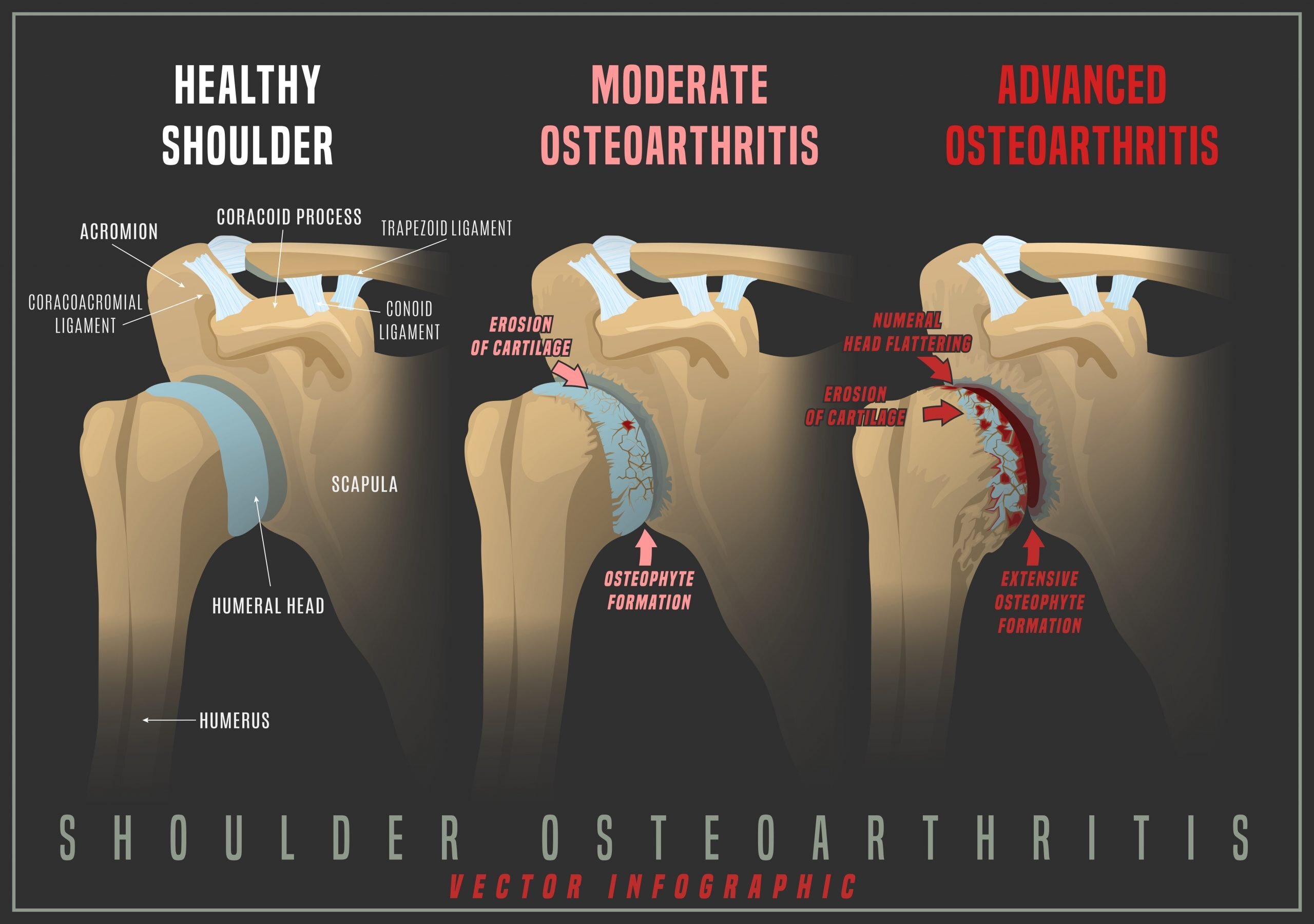 Shoulder arthritis