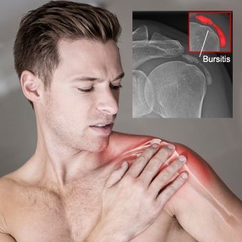 Shoulder bursitis