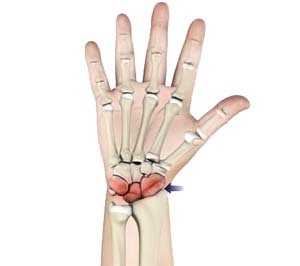 Wrist Arthritis