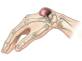 Ganglion Cyst