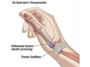 De Quervain Tenosynovitis