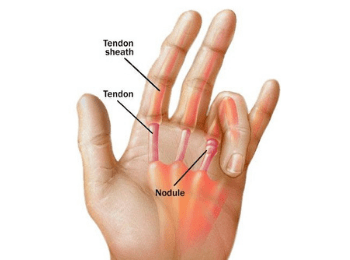 Trigger Finger and Trigger Thumb