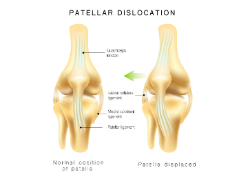 Patella Dislocation