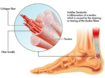 Achilles Tendonitis