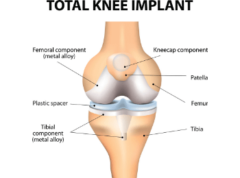 Knee Replacement