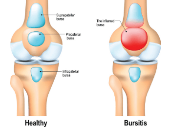 Bursitis Knee