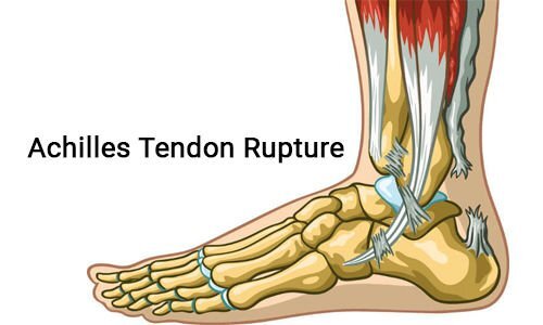 Achilles Tendon Rupture