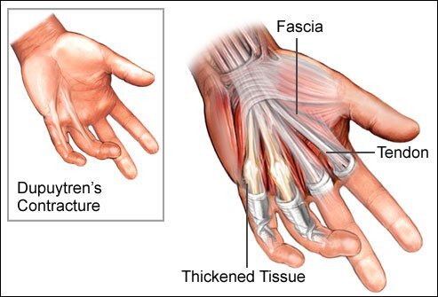Dupuytren's Contracture