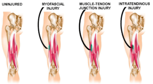 Hamstring Injury