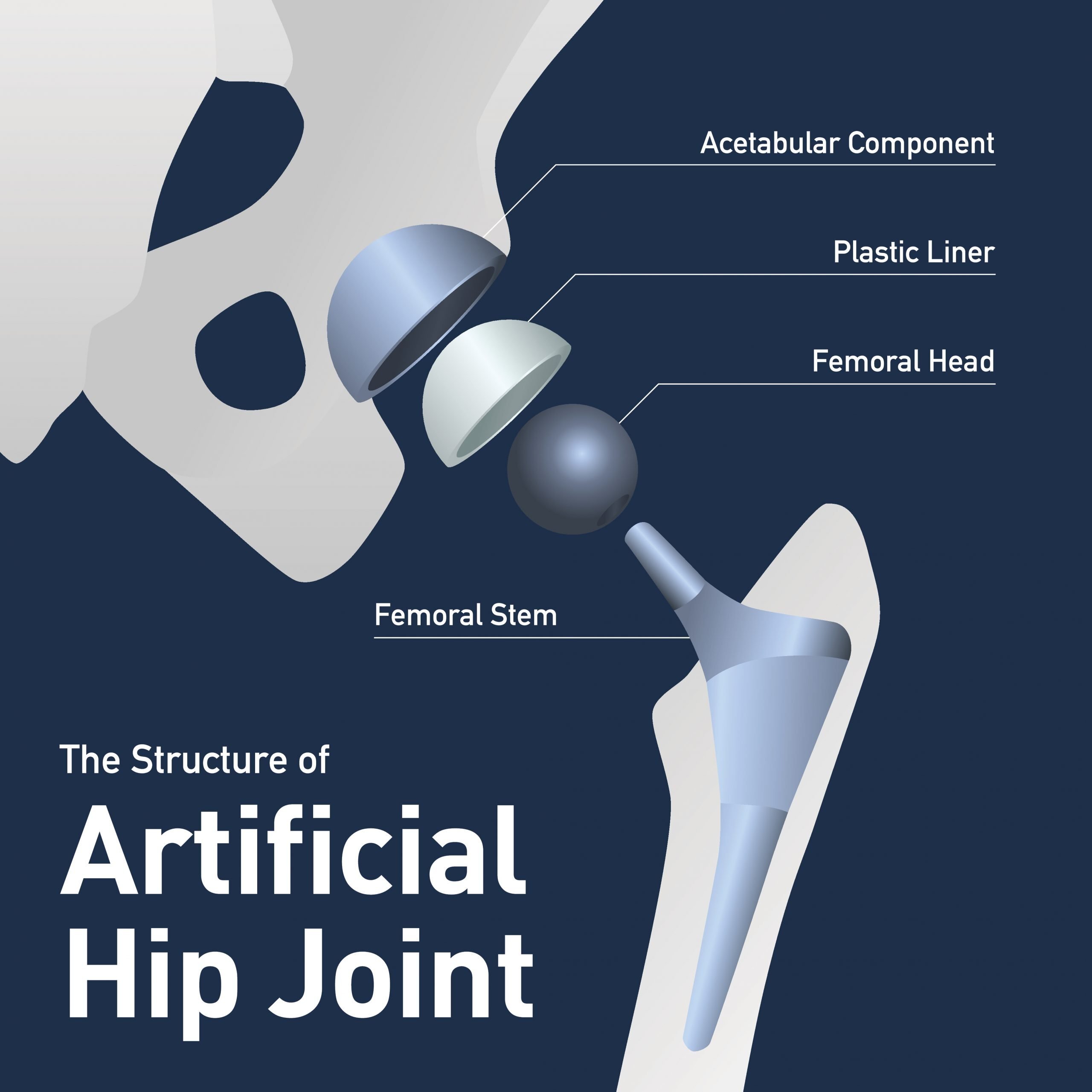 Hip Replacement
