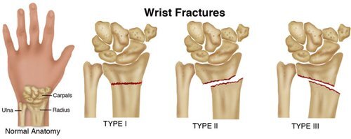 Wrist Fractures