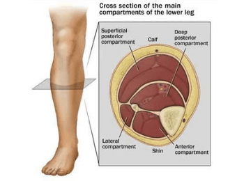 Compartment Syndrome