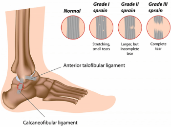 Sprained Ankle