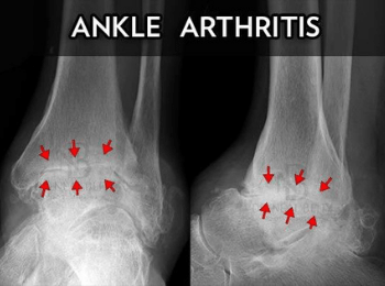 Ankle Arthritis
