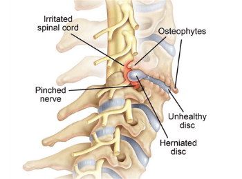 Cervical Disc Injury