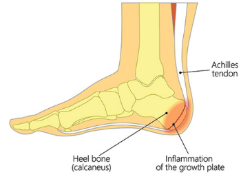 Sever's Disease
