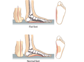 Flat Feet - Pes Planus