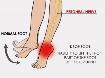 Foot Drop