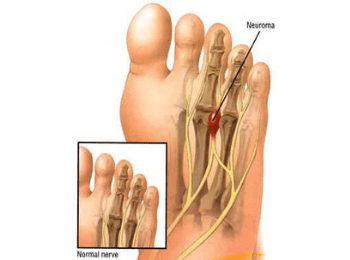 Mortons Neuroma