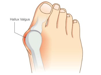 Bunion