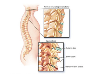 Cervical Spondylosis