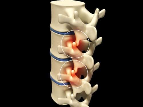 Cervical Facet Joint Sprain Cervical Facet Joint Sprain