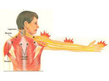 Cervical Radiculopathy