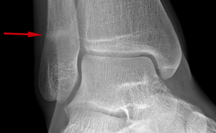 Stress Fractures Foot and Ankle