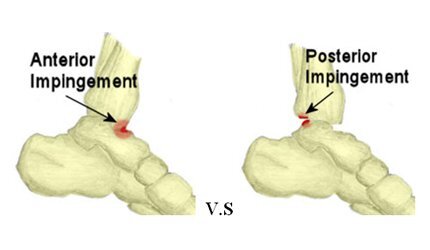 Ankle Impingement
