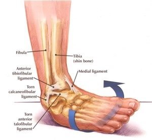 Ankle Ligament Injuries