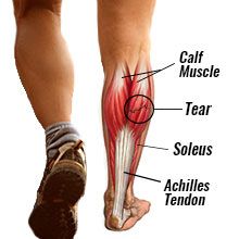 Torn Calf Muscle