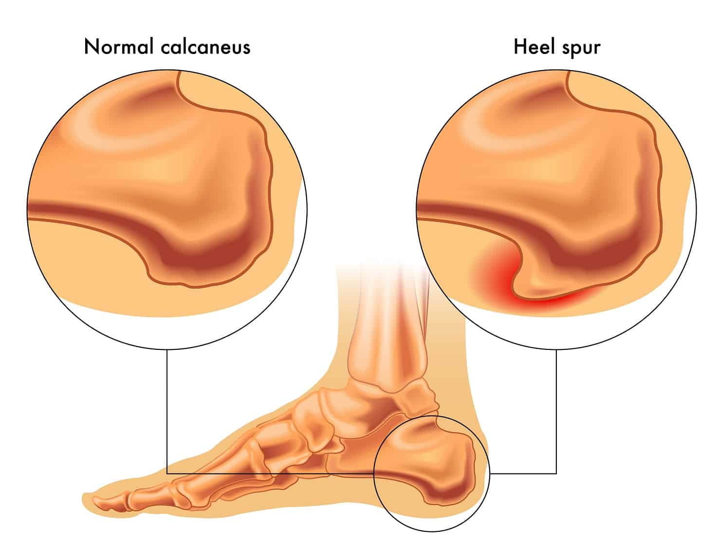 Heel Spur