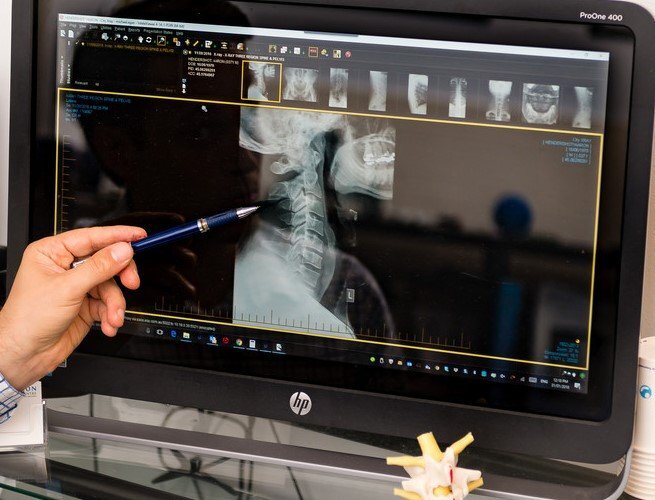 Chiropractic Care X-Ray Analysis - Sydney