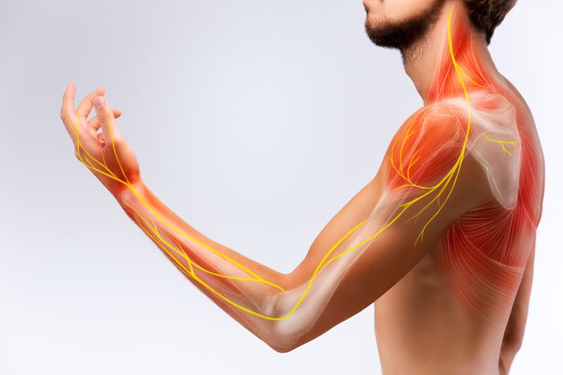 Neck Arm Pain