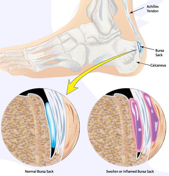 Retrocalcaneal Bursitis