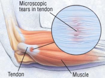 Tendinopathy/Tendonitis